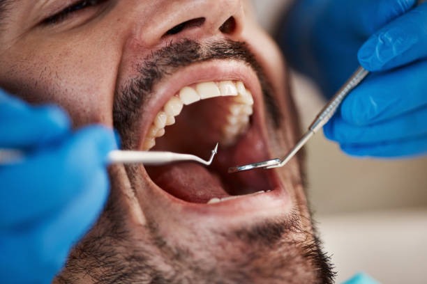 Best Emergency Wisdom Teeth Removal in Hornsby Bend, TX